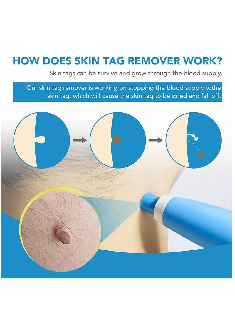 Auto Skin Tag Remover Kit For Face & Body, Skin Tag Remover Pen